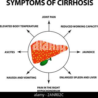 Les symptômes de la cirrhose. L'infographie. Vector illustration sur fond isolé Illustration de Vecteur