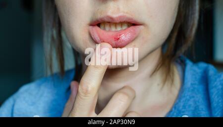 Close up of woman lèvres avec blessures. La violence à la maison. Banque D'Images