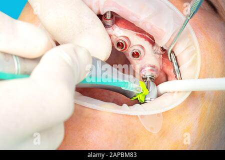 Gros plan sur la chirurgie d'implant guidée numérique chez le patient - nouvelle technologie d'implant en dentisterie. Banque D'Images