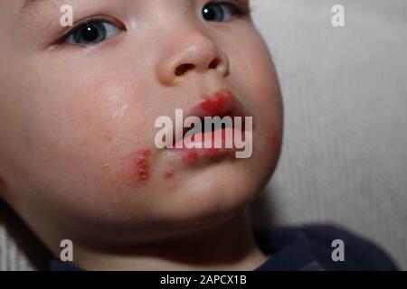 Maladie du virus de La Bouche Du Pied de la main chez l'enfant Banque D'Images