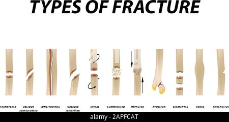 Types de fracture. Jeu d'os de fracture. Infographies. Illustration vectorielle sur un arrière-plan isolé. Illustration de Vecteur