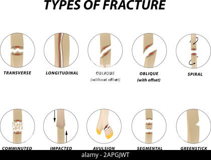 Types de fracture. Jeu d'os de fracture. Infographies. Illustration vectorielle sur un arrière-plan isolé. Illustration de Vecteur