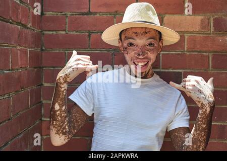 Portrait de jeune homme avec vitiligo portant un chapeau et faisant le signe surfer Banque D'Images