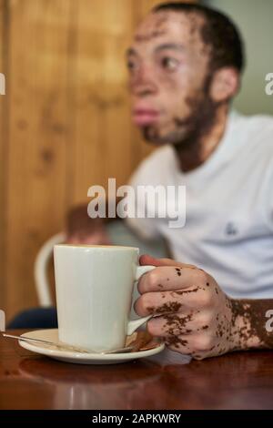 Jeune homme avec vitiligo assis dans une cafétéria et tenant une tasse de café Banque D'Images