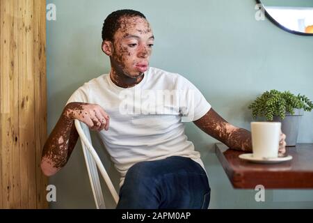 Jeune homme avec vitiligo ayant une tasse de café dans une cafétéria Banque D'Images