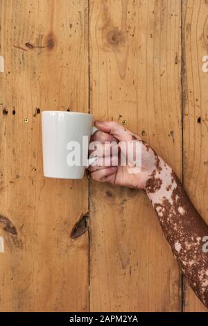 Gros plan de la main d'un homme avec vitiligo tenant une tasse de café sur un mur en bois Banque D'Images