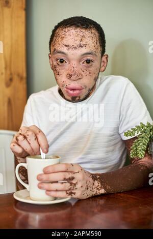 Jeune homme avec vitiligo ayant une tasse de café dans une cafétéria Banque D'Images