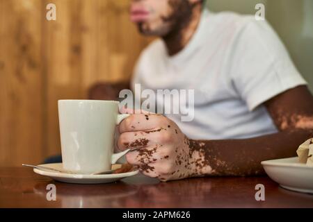 Gros plan de la main d'un homme avec vitiligo tenant une tasse de café Banque D'Images