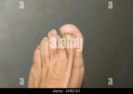 Jeune gars pieds nus doigts avec des ongles d'onycho malade mycosis, problèmes dermatologiques Banque D'Images