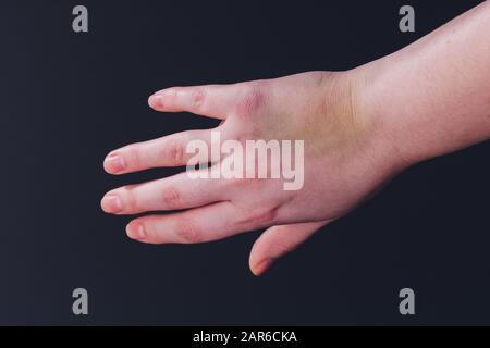 Main féminine avec une grosse bruise sur fond blanc. Traitement de pommade. Violence familiale ou pas de prudence Banque D'Images