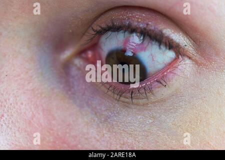 Œil Après Lasik Montrant Le Vaisseau Sanguin En Rafale. Lésion Oculaire Au Laser, Extravisation De La Cellule De Sang Rouge. Yeux de saignement, macro, gros plan, femme avec maquillage Banque D'Images