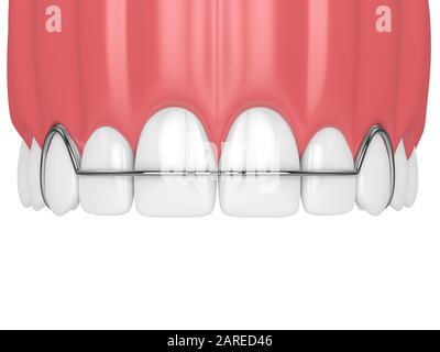 rendu tridimensionnel de la mâchoire avec dispositif de retenue orthodontique amovible sur fond blanc Banque D'Images