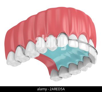 rendu tridimensionnel de la mâchoire avec dispositif de retenue orthodontique amovible sur fond blanc Banque D'Images