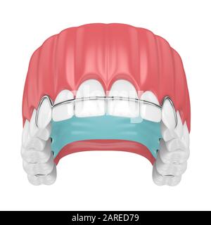 rendu tridimensionnel de la mâchoire avec dispositif de retenue orthodontique amovible sur fond blanc Banque D'Images