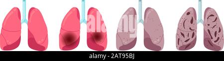 Ensemble de progression des maladies pulmonaires. Inflammation saine pneumonie et tuberculose infection virale. Virus interne de l'organe du système respiratoire humain frappé. Anatomie médicale dommages vecteur eps illusrtation Illustration de Vecteur