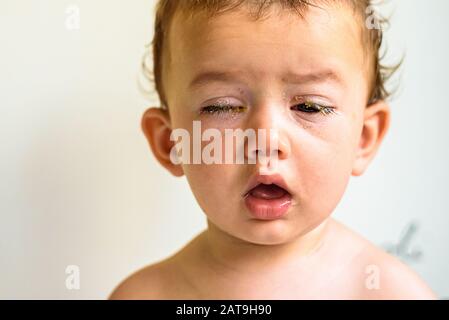 Yeux d'un bébé atteint de conjonctivite bactérienne purulence. Banque D'Images