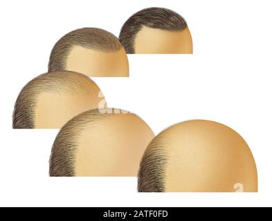 Stades de la calvitie et de la perte de cheveux de tête chauve comme un amincissement cosmétique de follicule de la ligne de cheveux et d'alopecia comme avant et après dans une illustration tridimensionnelle. Banque D'Images