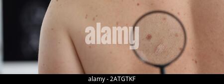 Plan Macro sur médecin contrôle mole Banque D'Images