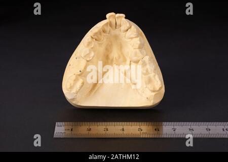 Section moulée en plâtre des dents inférieures avec incisives saillantes de l'homme d'âge moyen pour produire une couronne dentaire dans les dents supérieures du compagnon. Banque D'Images