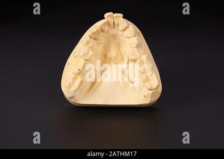 Section moulée en plâtre des dents inférieures avec incisives saillantes de l'homme d'âge moyen pour produire une couronne dentaire dans les dents supérieures du compagnon. Banque D'Images