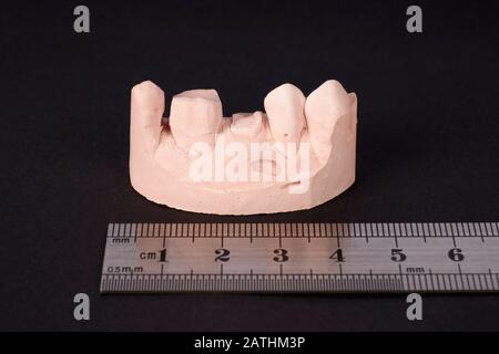 Section en plâtre des dents supérieures gauche de l'homme d'âge moyen pour produire une couronne dentaire. Banque D'Images