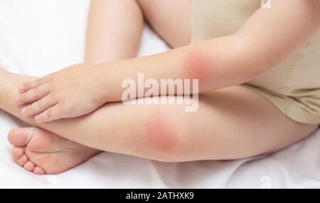 Les mains et les pieds d'un jeune enfant qui a une éruption cutanée et une rougeur sur la peau. Le concept de traitement des maladies et des soins de la peau chez les enfants, contexte Banque D'Images