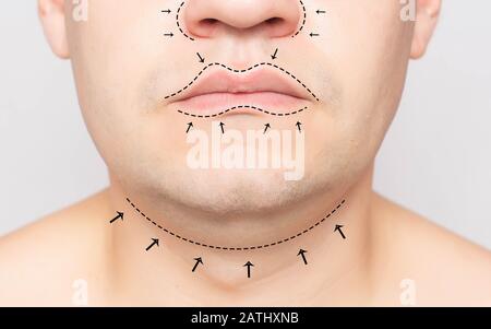 Le visage d'un homme marqué d'un marqueur avant la chirurgie plastique. Concept de lifting, rhinoplastie, ablation du menton double en chirurgie plastique, clinique Banque D'Images