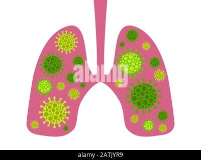 Infection dans les poumons. Coronavirus 2019-nCoV, syndrome respiratoire du Moyen-Orient. Illustration vectorielle Illustration de Vecteur