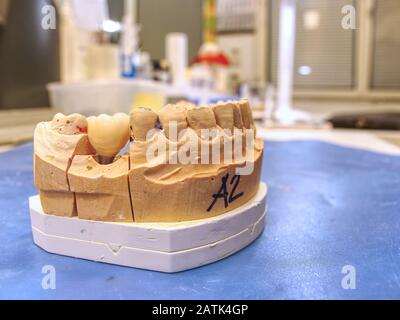 Prothèse dentaire en semiprocess. Test de la dent artificielle, prothèse dentaire moderne fait main implantat céramique. Le dentier, de fausses dents. Banque D'Images