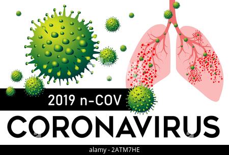 2019 n Cov Coronavirus de Chine Poumons Pneumonie Illustration vectorielle avec infection Par Virus et réponse inflammatoire pulmonaire. Illustration de Vecteur