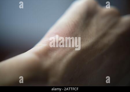 Marque de moustique sur le dos de la main Banque D'Images