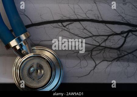 Stéthoscope sur l'image médicale des artéris dans l'artère bloquée leg.cholesterol, fumer. Banque D'Images