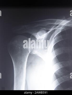 La radiographie de l'épaule à rayons X du film montre une maladie dégénérative de l'arthrose de l'articulation glenohumérale et acromioclaviculaire Banque D'Images