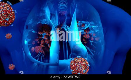 Infection pulmonaire du coronavirus, illustration conceptuelle Banque D'Images