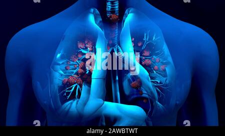 Infection pulmonaire du coronavirus, illustration conceptuelle Banque D'Images