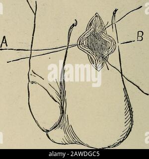 Chirurgie opératoire, pour étudiants et praticiens . ^forceps puis couper pour que nous ayons deux ligatures. Ces ligatures, qui entourent toutes les structures du cordon qui ont été sepa-. Fig. 291.—Varicocèle. Les déferres de vas et les vaisseaux adjacents (A) se sont séparés des autres structures du cordon, de l'artère spermatique et du plexus pampiniforme (B). Les ligatures ont été liées vers B ci-dessus et belowpréparatoire pour exciser la partie intervenant. Notées du canal déférent, etc., sont liées, une au-dessus et l'autre ci-dessous. La portion intervenant est excitée avec les ciseaux, pas tooc Banque D'Images