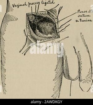 Chirurgie opératoire, pour les étudiants et les praticiens. Canal guinal, émergeant à l'anneau inguinal externe. Comme il émergesde l'anneau externe, il se trouve juste sous le tégument dans la graisse sous-cutanée, et descend dans le scrotum, où il est joint à la bordure postérieure du testicule. Il est environ aussi épais autour que le doigt fragile, et est composé d'un ensemble de structures: Le canal déférent, l'artère du vas déférent, et l'artère crematrique, leurs veines corre-éponding, l'artère spermatique, et un plexus veineux tortueux, la pampiniforme. Le canal déférent, le conduit efferent du t Banque D'Images