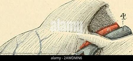 Sécurité d'anatomie humaine . évrotiquesde se dégorger dans les veines superficielles, ou, vice versa, au sang veineuxdu réseau superciel demprunter le réseau profond pour se rendre au cœur. 4 Critale postérieure. — Pendentiamment des trois veines antibraciales quenous venons de pleurer, on en rencontre assez frémisment une quatrième quichémine sur le plan dorsal et quon appelle, pour cette raison, veine cubitale pos-supérieure. This veine, quand elle existe, pneu fils origine de larcade veineuse dudos de la main. De là, elle se dirige vers lepitrochlée, en suivant la face posté-rieure de la Banque D'Images