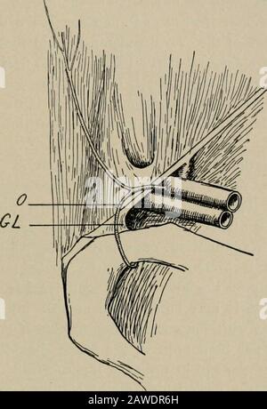 Chirurgie opératoire, pour les étudiants et les praticiens . varient; ils peuvent être composés d'intestin, grand ou petit; de l'omentum, ou des deux; et occasionnellement il peut y avoir d'autres organes, tels que la vessie, l'ovaire, etc. Après le sac a été freelyouvert, son contenu devrait être examiné. Toute bande de constriction dans le corps du sac devrait être divisée, et une tentative a ensuite fait mouler l'intestin vers le bas afin de l'atténuer au point de constriction; buutin cet effort beaucoup de force ne devrait pas être utilisé. Un effort est fait pour LES OPÉRATIONS DE HERNIE. 617 insérez le doigt dans le cou du sac, et, si cela réussit, un Banque D'Images