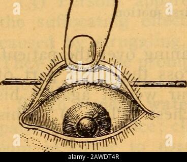 Les instructions de la force d'atterrissage et du petit bras, marine des États-Unis, 1905 . peuvent avaler. Donot le retirer jusqu'à ce qu'il soit conscient et respire naturellement. Suffocation. 12. La suffocation de corps étrangers dans le tuyau d'air, de pendaison, et de l'inhalation de gaz toxiques, est traitée en éliminant la cause, et en procédant avec respirationartificielle dans le cas de suffocation de noyade. Une ligne doit se défaire rapidement à un homme avant de l'envoyer dans un vieux puits, une excavation suspecte ou en présence de gaz irrespirables. LE TRAITEMENT DES ACCIDENTS ET DES URGENCES. 13. Foreig Banque D'Images