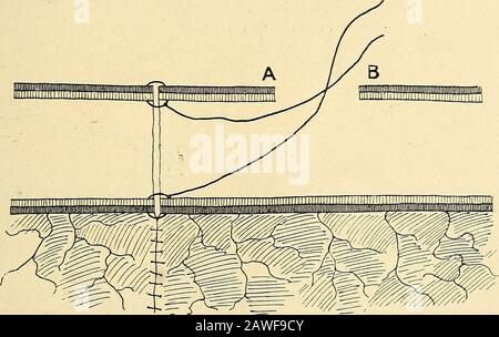 Blessures en guerre : le mécanisme de leur production et de leur traitement . Fig. 8°c... Fig. 8 i. des deux extrémités de l'intestin, et à environ un quart de pouce des extrémités. Lorsque autant de sutures que possible nécessaires ont été mises en place et attachées, les sutures de traction sont coupées, et l'invagination a diminué, 356 BLESSURES EN GUERRE, mais plus par manipulation que traction, et l'incision longue-dinale fermée par Lemberts suture (fig. 84). Tous les Banque D'Images