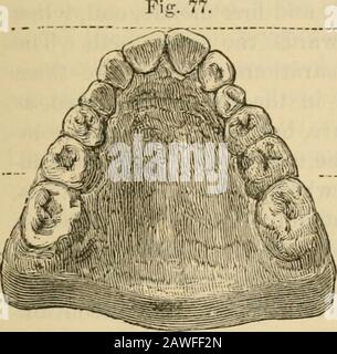 Manuel de chirurgie dentaire et de pathologie . KigB. 7 i5 et 70 cas n-jiresent 2, dans lequel l'enlèvement des premiers bicuspides de la mâchoire supérieure seulement est recommandé. enlever l'ujipper premier bicusi)ide8 seulement, et l'action de la lipswould ] biing strobarly tlie projetant teetli en bonne position. IRREGULARTIGS DANS LES DENTS PERMANENTES, LUL Si les incisives reposent sur la lèvre inférieure, nous devons en outre utiliser la plaque illustrée à la Fig. 37, p. 73, pour les dessiner Fig. 78. Banque D'Images