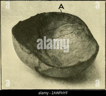 Blessures en guerre : le mécanisme de leur production et de leur traitement . Fig. 68 b Gorges de la table extérieure du crâne sans blessure à la table intérieure, par balle.Voir Fig. 68 C.—Musée Netley.. Fig. 68 C.A. Barre de coupe intérieure en face de la rainure de la table extérieure. —Netley Museum. D'élévation ou d'enlèvement de fragments, ou pour laver les caillots d'outremer et la ligature des vaisseaux de saignement. Quand, plus tard dans le cas, les symptômes du cerveau ou du meningial dans- Banque D'Images