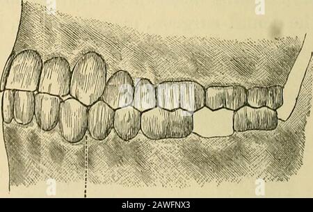 Manuel de chirurgie dentaire et de pathologie . Modèle tiré d'un fnicoturo vertical de la mâchoire inférieure entre le cuspidatus gauche et le premier bicuspide. La ligne pointillée, qui indique la fracture, est la ligne à scier pour amener le modèle dans la position normale de la mâchoire. Consiste à construire une plaque de métal qui s'enfermer et tenir solidement plusieurs des dents des deux côtés de la blessure.Pour ce faire, Les impressions de cire ou de plâtre sont prises des deux mâchoires, la fracturée dans sa position anormale ; de ces plâtre Fig. 57. La gravure nhème comment, au moyen d'un moulage de la tipp Banque D'Images
