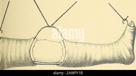 Blessures en guerre : le mécanisme de leur production et de leur traitement . Fig. 49.—les éclats De Fil de Rosers pour Les Coups De Feu du genou. Fig. 50. Banque D'Images