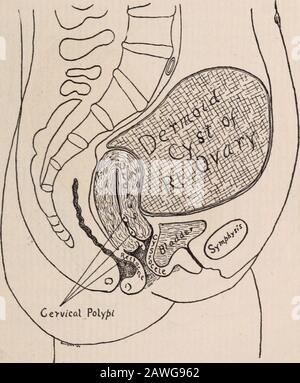 Annals médicaux d'Albany . -. On pensait que la vascularisation de la grossesse pourrait expliquer le saignement de la polypie cervicale. Comme aucun des autres signes de grossesse n'a été trouvé, ceci a été exclu et un diagnostic probable a été fait soit de croissance intra-utérine d'amalignant ou, ce qui était encore plus probable, un grand, doux sous-mucus myome. Lors de l'opération du 10 mai 1905 à l'hôpital d'Albany, un dermoidcyste de l'ovaire droit a été trouvé qui était situé dans la médianline et s'était moulé sur le fundus de l'utérus, formant ainsi ap-parently une tumeur utérine. (Voir Fig. II.) le t Banque D'Images