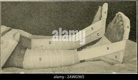 La salle d'opération et le patient; un manuel de traitement pré- et post-opératoire . t beenso préparé il peut être facilement stérilisé en le faisant passer à l'aflame. En appliquant du plâtre sur les bords approximatifs de la plaie, l'espace doit être laissé entre les bandes pour permettre l'évacuation de 60 OFERATIXG ROOM AXD LA décharge PATIEXT qui peut se former. Si les extrémités sont tournées sous pour l'adistance d'un quart de pouce ou ainsi, et les surfaces stuckensemble, les bandes peuvent être les plus reachly soulevées et avec moins d'ennui au patient que si les extrémités sont directement appliquées à la peau. Plâtre de résine, lorsqu'il est utilisé Banque D'Images