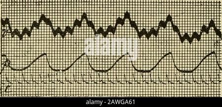 Un manuel de physiologie pour les étudiants en médecine et les médecins . sériesdes impulsions nerveuses pendant l'inspiration (Fig. 280). Quand par aspiration les poumons ont été effondrés, une autre variation électrique d'un différent * Pour la discussion et la littérature, voir Meltzer, Archiv F. Physiologie,1892, P. 340; New York Medical Journal, 18 Janvier 1890. Leswan-dowsky, Archiv F. Physiologie, 1896, p. 195 et 483. Feinthoven, Quarterly Journal of Exp. Physiologie, 1908, 1, 243;recherche également du Laboratoire Physiologique de l'Université de Leyden, VII., 1908. 684 PHYSIOLOGIE DE LA RESPIRATION. Le caractère a été produit Banque D'Images