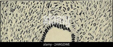 Gynécologie . n'atteignent pas une taille aussi grande. La signification clinique des kystes séreux dépend beaucoup de la question de savoir si les ornot sont papillomatous. La variété non papillaire est généralement bénigne et ne se reproduit pas après l'opération, mais il est possible qu'un non-papillarycystoma apparemment peut se reproduire rapidement sous forme cancéreuse, la croissance papillaire ayant ex-istée microscopiquement dans la paroi de la tumeur originale. Nouveaux GROGNEMENTS 337 Les tumeurs papillaires sont d'une importance clinique plus grave en raison de la tendance théirplus grande à la dégénérescence maligne, et en raison de la possibilité d'oimplantation du papillome Banque D'Images