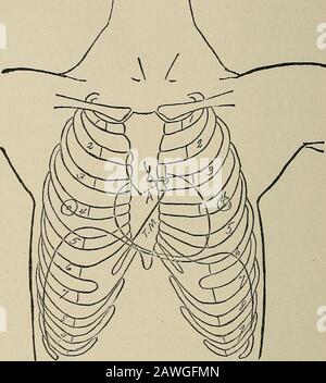 Chirurgie opératoire, pour les étudiants et les praticiens . T. Les Contours du coeur sur la paroi thoracique.—La bordure Inférieure du coeur correspond à la ligne de jonction entre le corps du sternum et son cartilage ensiforme. Le bord supérieur du cœur correspond à la bordure supérieure du cartilage soif. À droite du sternum se trouve l'auricule droite, sa limite correspondant à une ligne courbe qui est tirée de l'extrémité théarticulaire du troisième cartilage costal vers le bas et à travers le cinquième cartilage costal près de son articulation avec le sternum. Le ventricule droit atteint le niveau Ove Banque D'Images